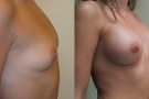 menší kulatý silikonový implantát umístěný částečně pod prsním svalem a zvětší části pod žlázou, augmentace prsou pohled šikmý